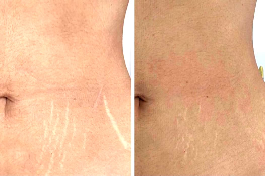 Spadeep Microplasma de Alma Laser para Cicatrices o Estrías