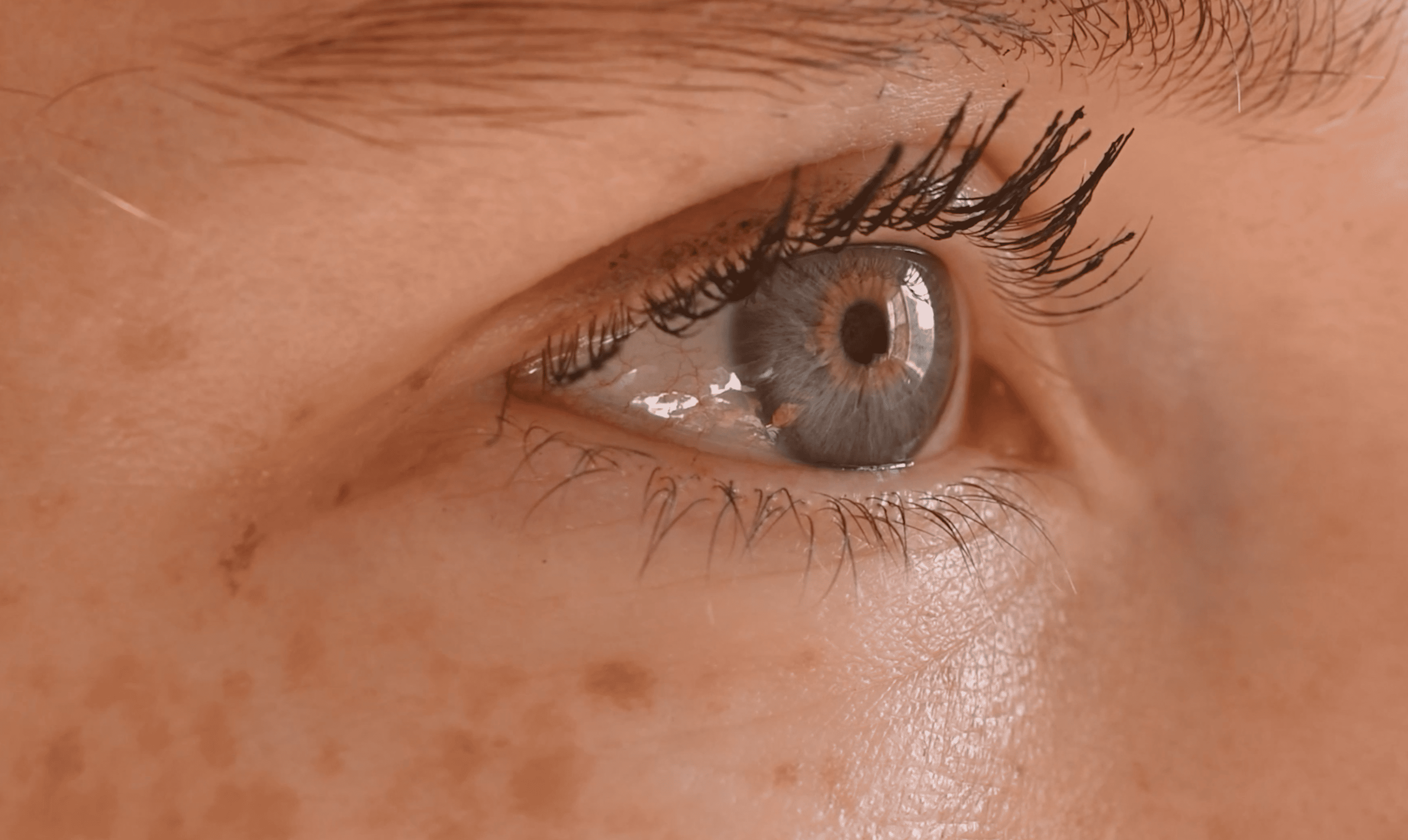 Mesoterapia Francesa