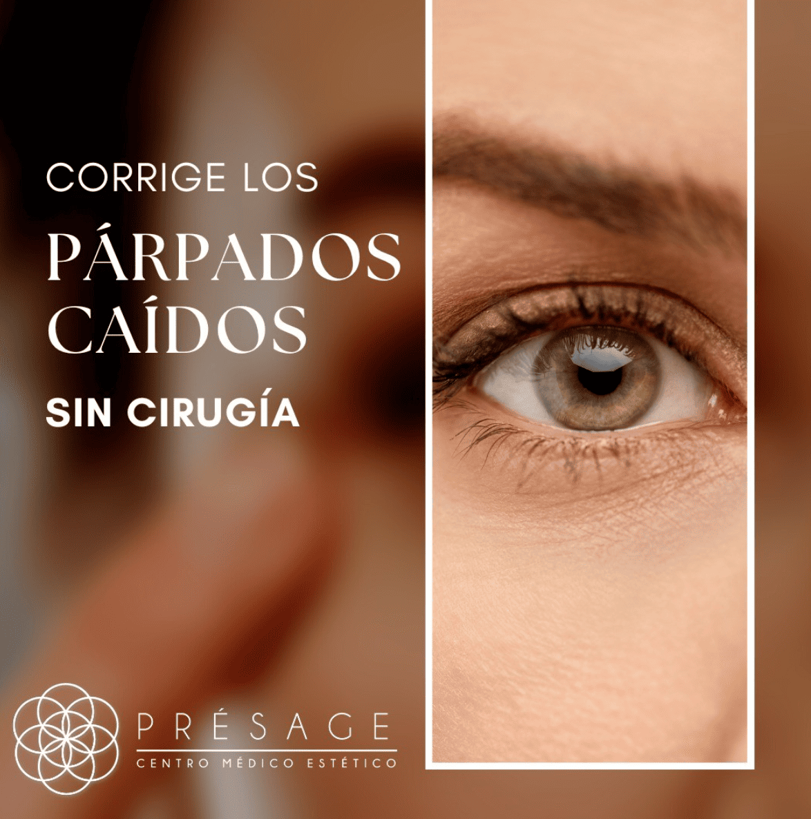 Rejuvenece tu mirada y elimina los párpados caídos sin cirugía.