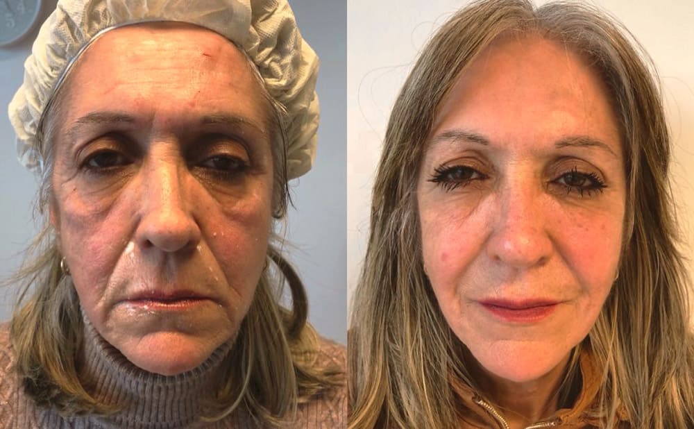 Diferencias entre tratamientos antiage: cómo elegir el más adecuado para tu piel